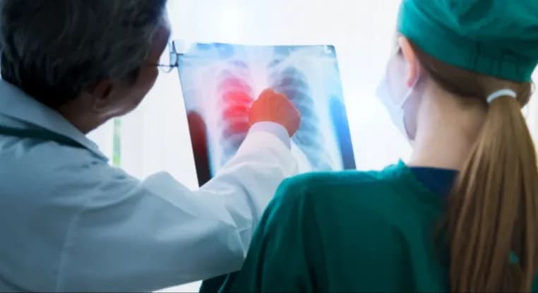 Cáncer de pulmón: una combinación de fármacos retrasa el empeoramiento de síntomas